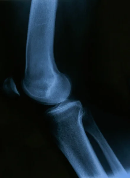 X-Ray of the Knee