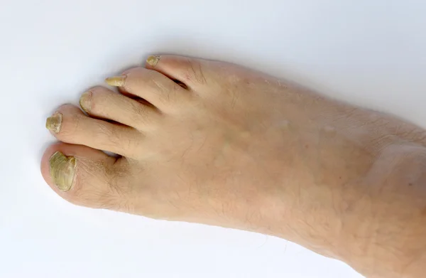 Tanto como que es posible curar el hongo de las uñas