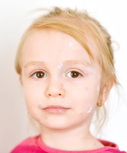 Baby girl with chicken pox rash
