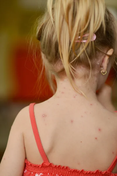 Baby girl with chicken pox rash