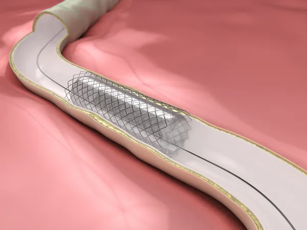 Coronary Angioplasty procedure - ballon with stent opening lumen artery