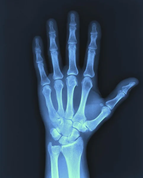 X-ray hand