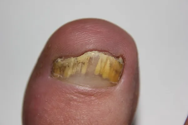 Nail Fungus