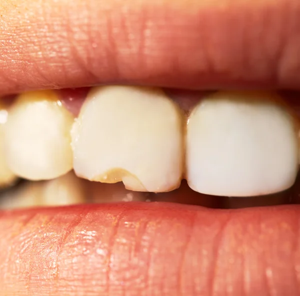 Macro shot of the broken tooth.