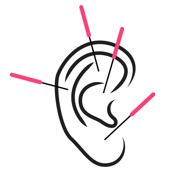 Illustration of ear acupuncture