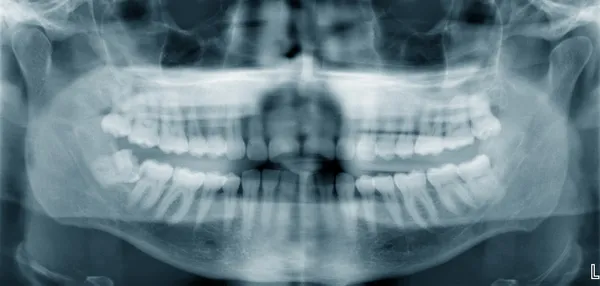 Panoramic dental x-ray
