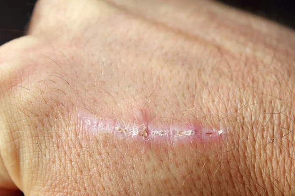 Scar on man hand