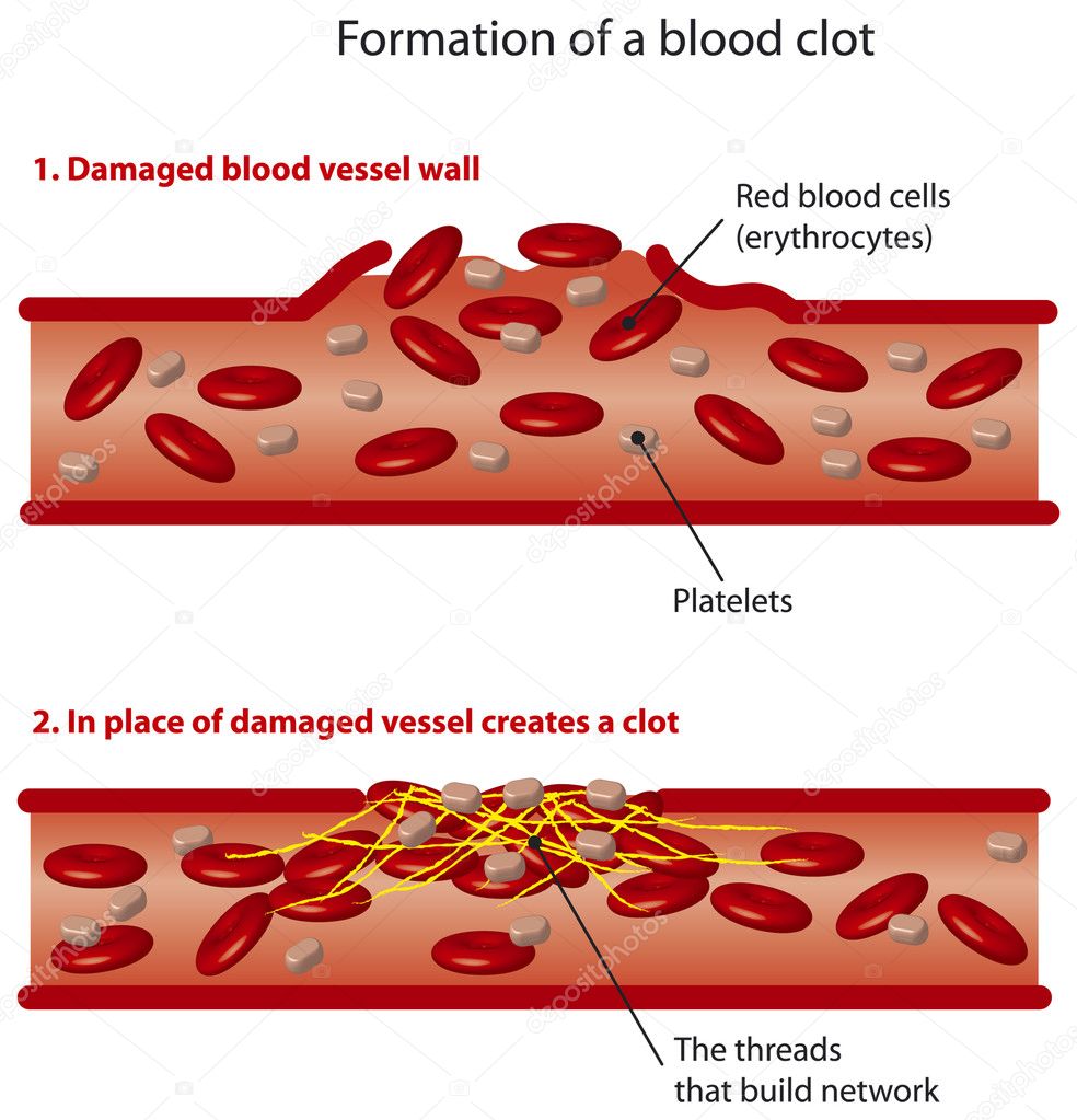 the reactions that affect the formation of blood clots Atrial fibrillation blood clots: symptoms and prevention eliquis is a newer-generation blood thinner that reduces your risk for blood clot formation and acne is caused by bacteria, inflammation, and clogged pores so where does alcohol come in can it affect acne here's. the reactions that affect the formation of blood clots Atrial fibrillation blood clots: symptoms and prevention eliquis is a newer-generation blood thinner that reduces your risk for blood clot formation and acne is caused by bacteria, inflammation, and clogged pores so where does alcohol come in can it affect acne here's.