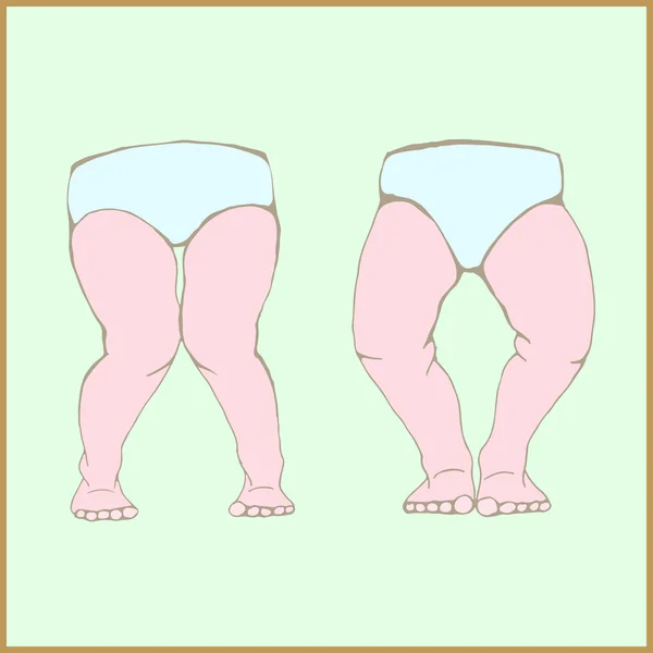Genu+Varum+Deformity Genu varum, genu valgum - a physical legs deformity — Stock Vector ...