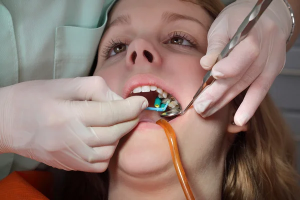 Dental procedure, filling tooth