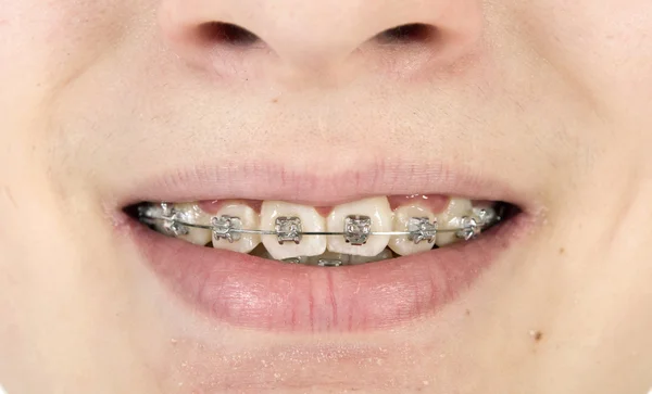 Orthodontics braces