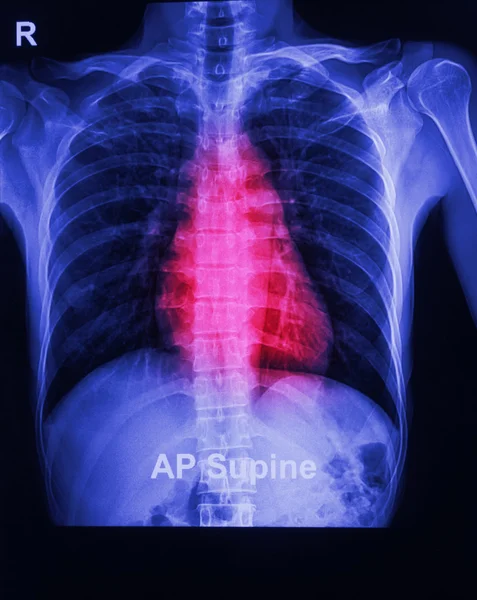 The x-ray image of a human chest