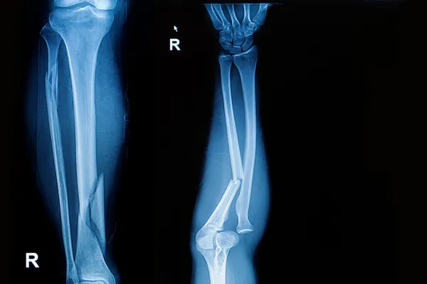X-ray image show fracture both bone of leg and fracture shaft