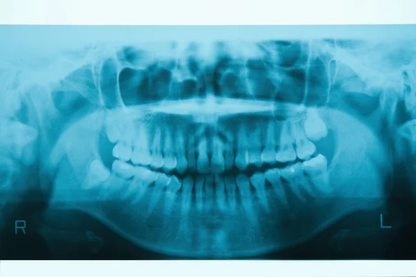 Panoramic dental X-Ray for Orthodontics and Jaw Orthopedics
