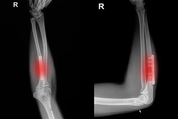 Film x-ray wrist fracture : show fracture radius bone (forearm\'s