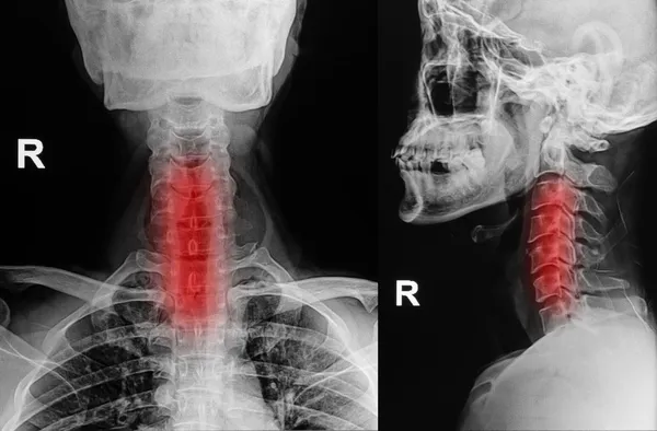 X-ray image of cervical spine, neck x-ray image