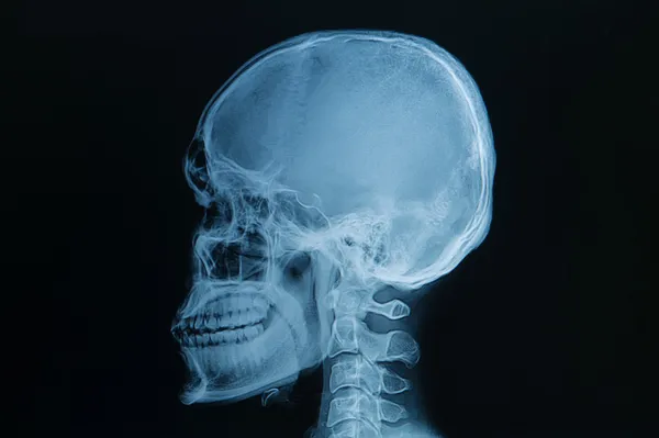 Skull x-rays image