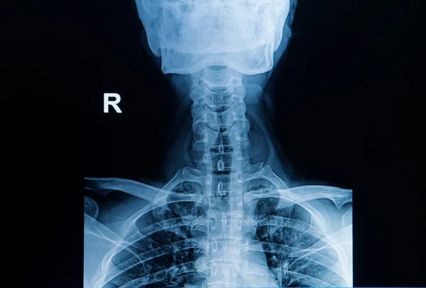 X-ray image of cervical spine, neck x-ray image
