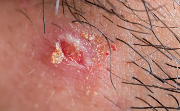 Exploded pimple