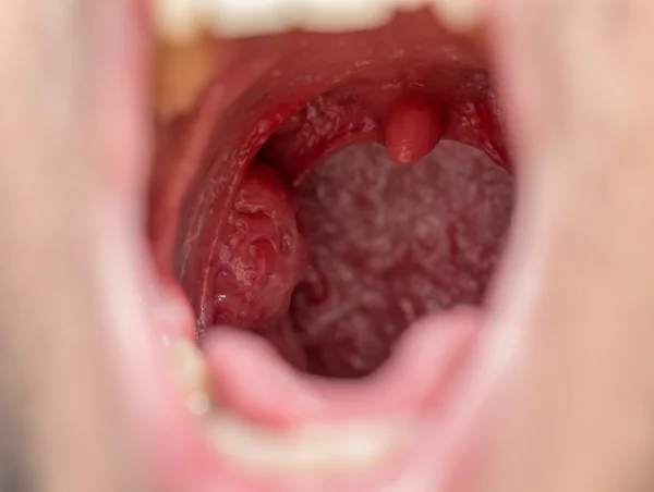 Open mouth view of tonsils