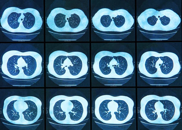 MRI scan of the human Lungs