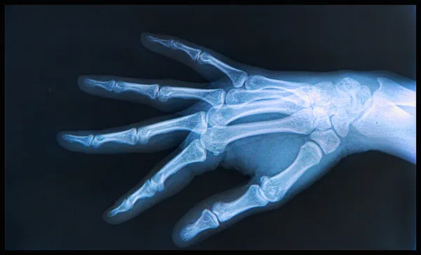 X-ray of human Hand