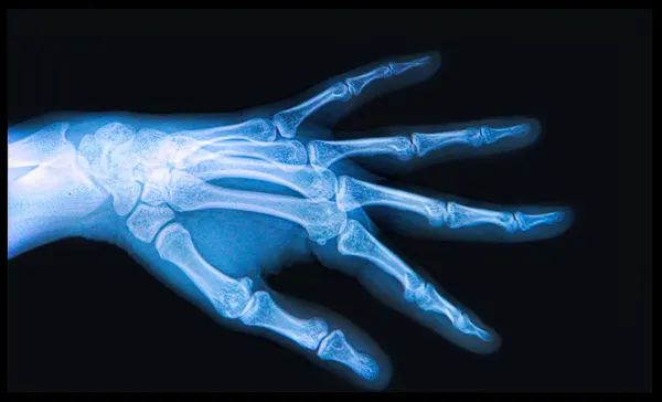 Xray of Hand and fingers