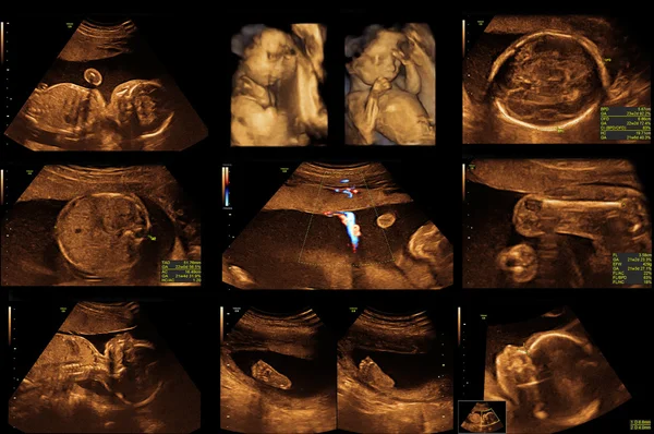 Baby on the ultrasound image