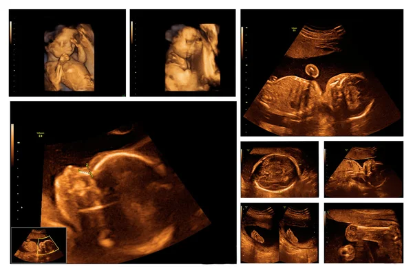 Child in the picture ultrasound