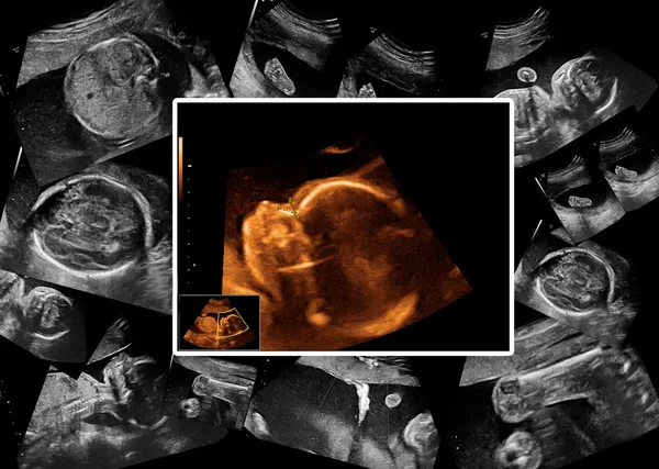 Baby on the ultrasound image