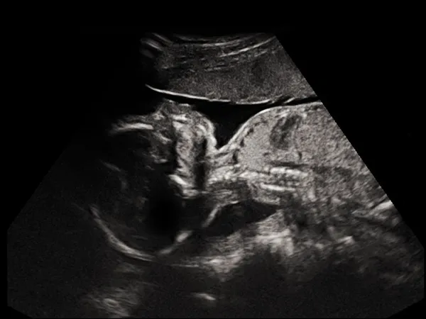 Child in the picture ultrasound