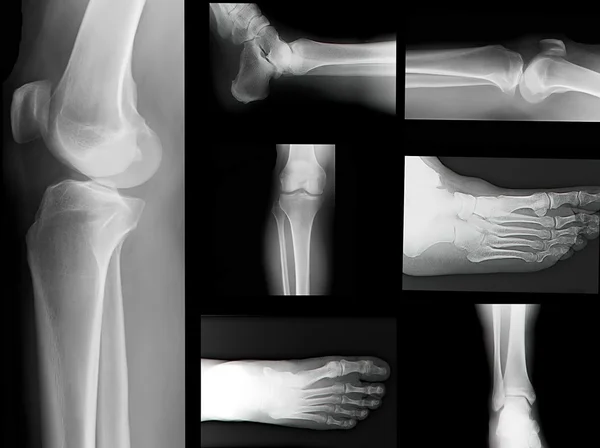 Human leg bone X-rays