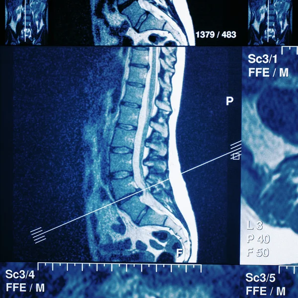 CT scan or mri of lower back