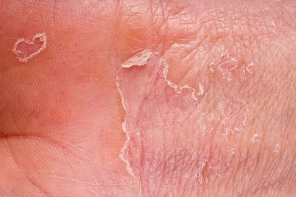 Medicina di psoriasi liquida