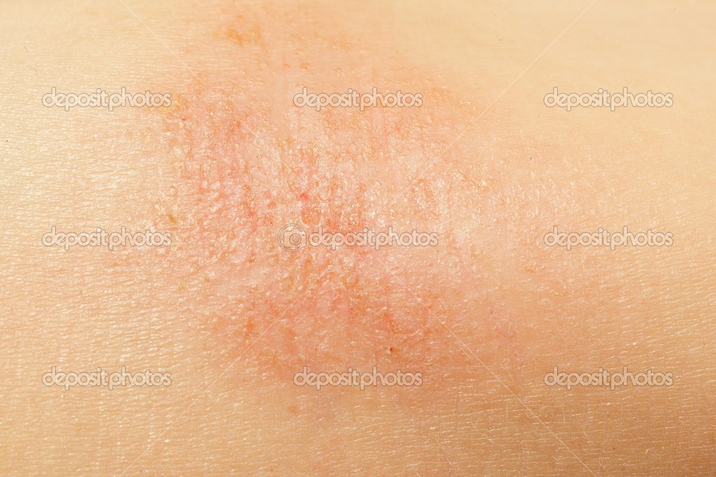 Eczema microbico al bambino un forum