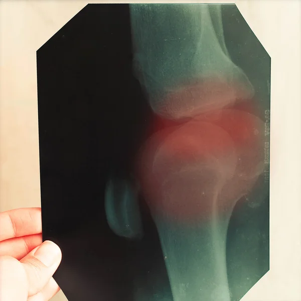X-ray of painful knee