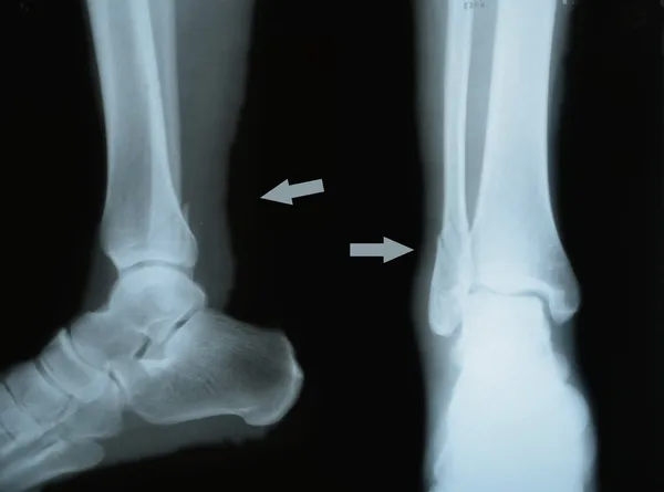 Double fracture of tibia, two projections, X-ray