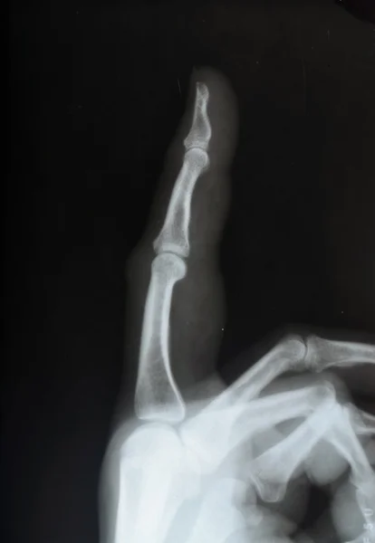 Dislocated finger, X-ray