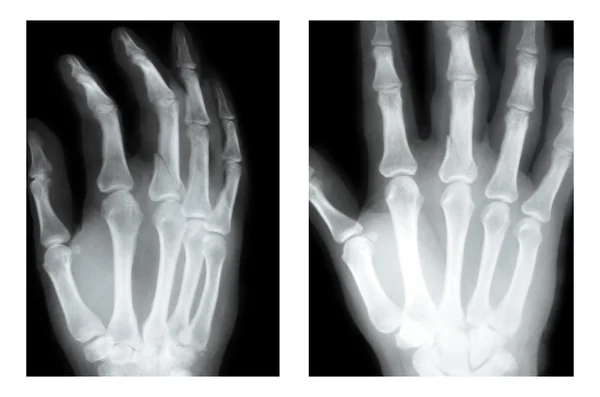 Boxer fracture, X-ray
