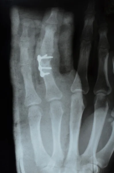 Hand, X-ray