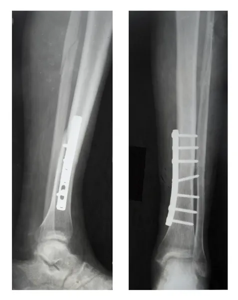 Leg fracture with displacement, X-ray