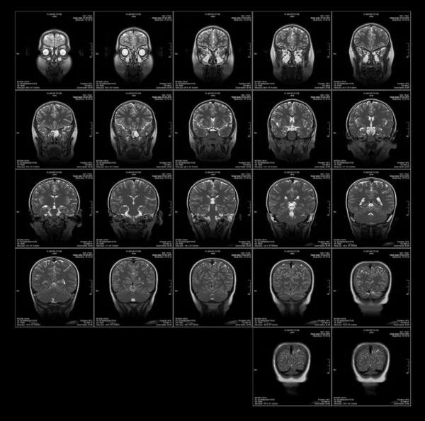 Real brain MRI slide of a girl