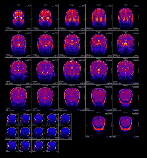 Real brain MRI slide of a girl