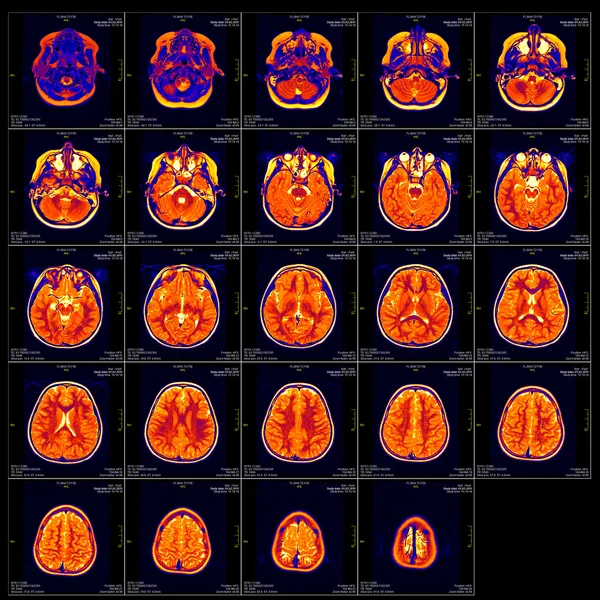 Real brain MRI slide of a girl