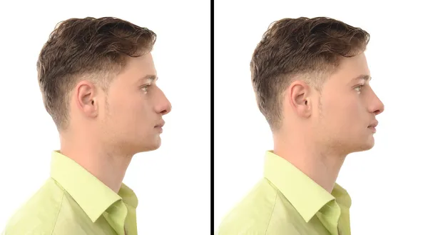 Man with rhinoplasty. Before and after photos of a young man with nose job plastic surgery.