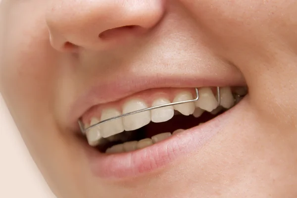The young girl smiling with braces on teeth