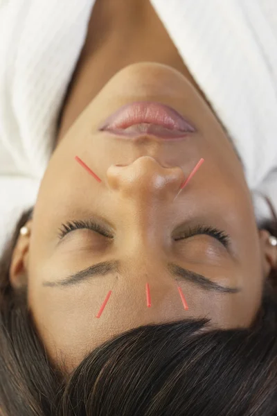 Acupuncture needles in African woman\'s face