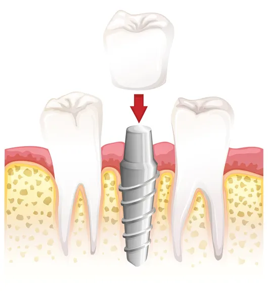 Dental crown procedure