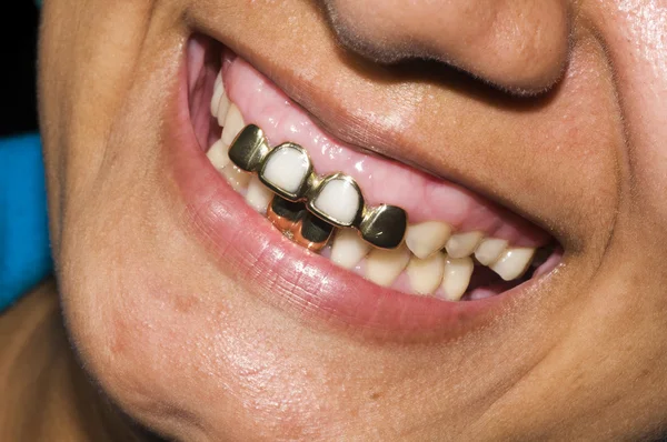 Gold teeth dentisty native corn island nicaragua