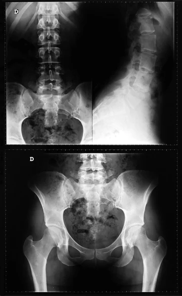 X-ray of the spinal column and pelvis of a woman